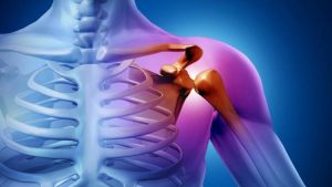 Защемленный нерв в плече: суть проблемы и методы борьбы с патологией
